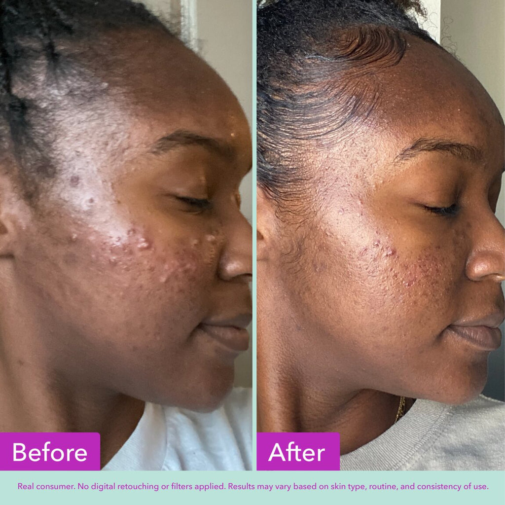 acne-foaming-cleanser-e3 zb_p.jpg